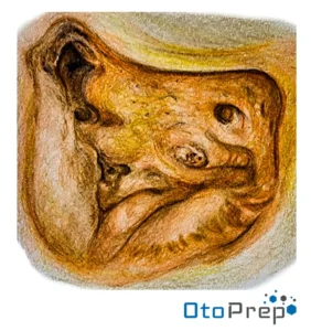 OtoPrep Endolymphatic sac surgical anatomy