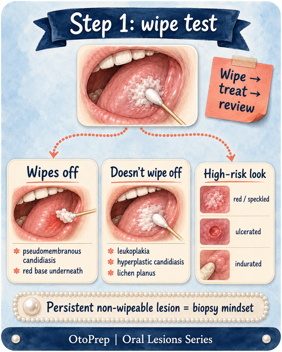 Step one wipe test for white oral lesions showing lesions that wipe off, do not wipe off and high-risk features.